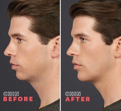 Chin - Before and After