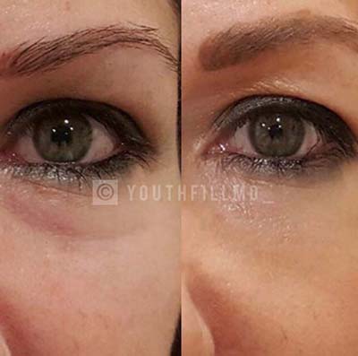 Filler Under Eyes - Before and After