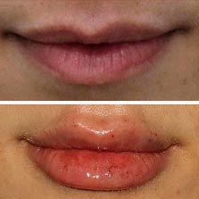 Filler Lips - Before and After