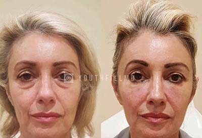Facial Rejuvenation - Before and After