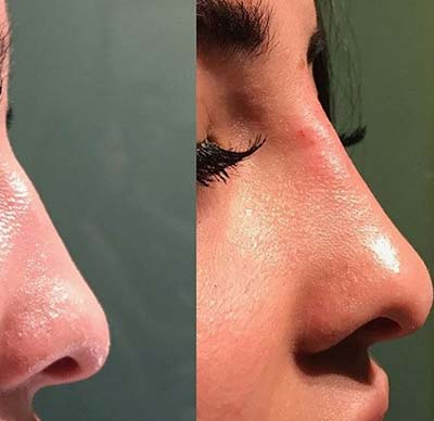Nose - Before and After