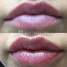 Filler Lips - Before and After