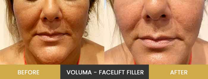 Before and After Medspa Photos in California