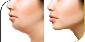 Kybella - YouthFill MD in Beverly Hills and Hollywood, CA