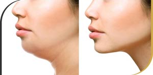 Kybella Treatment in Beverly Hills, Hollywood and Greater Los Angeles CA